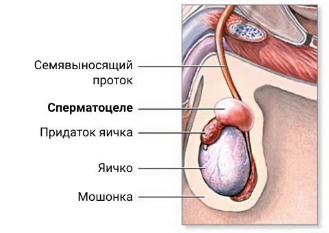 Киста яичка