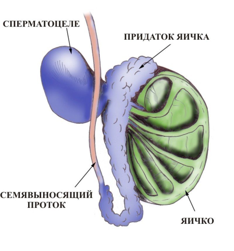 Киста придатка яичка