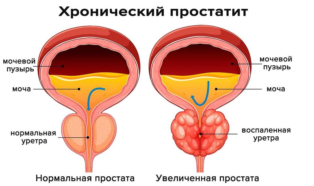 Простатит